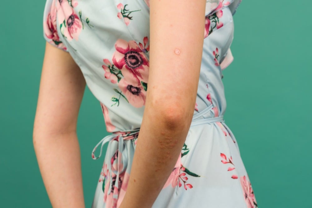 Psoriasis Vulgaris