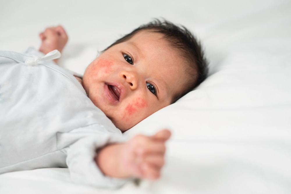 Penyakit kulit pada bayi